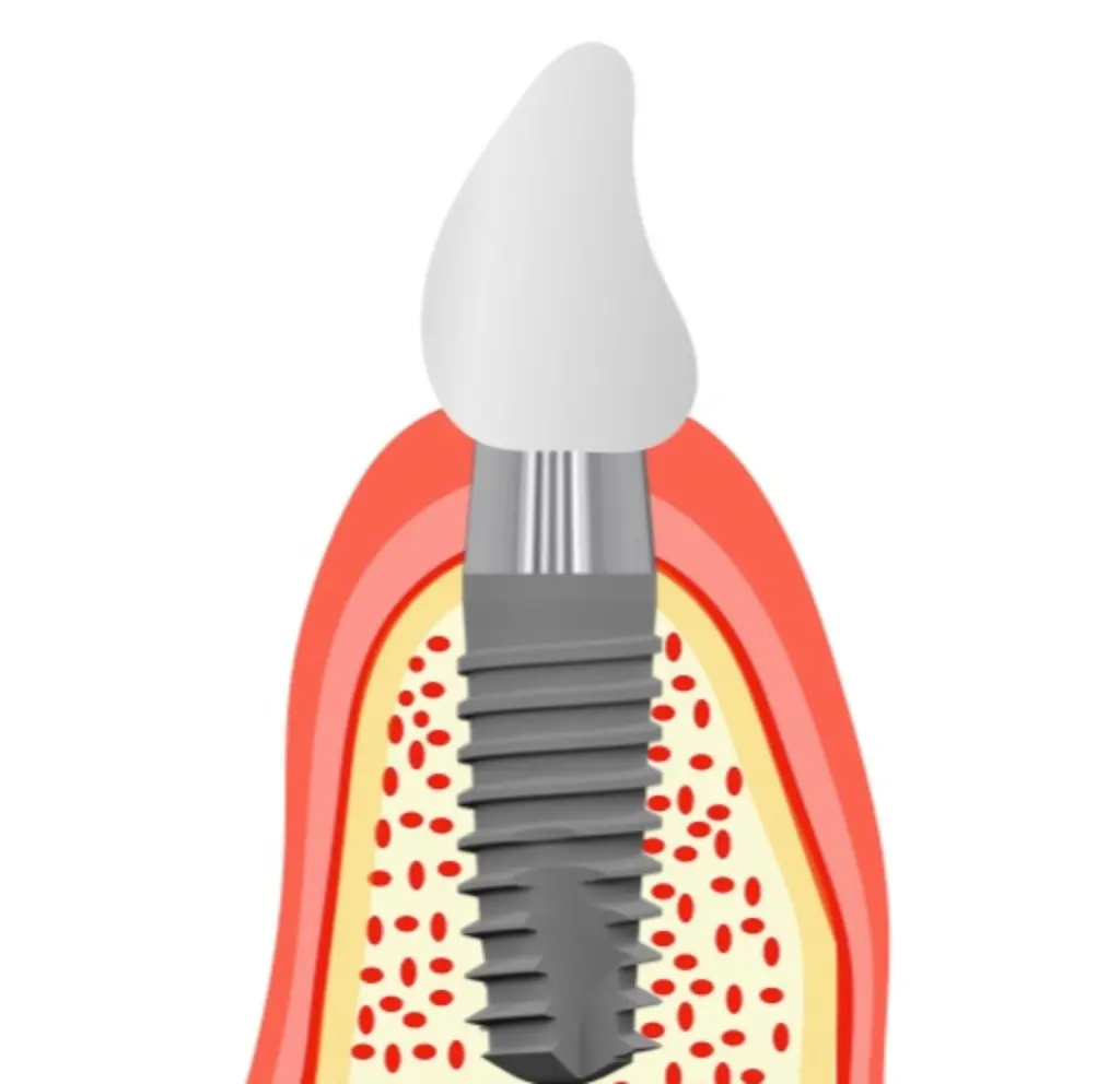 Impianti dentali Transmucosi